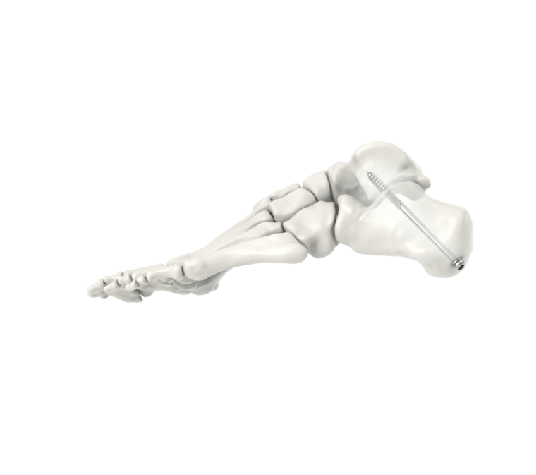 Inlet™ Cannulated & Headless Screw System - Advantage Medical